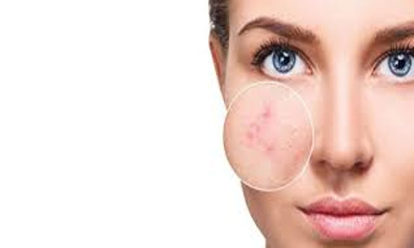 Tips on Maintaining Acne Free Skin